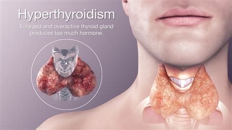 Hyperthyroidism